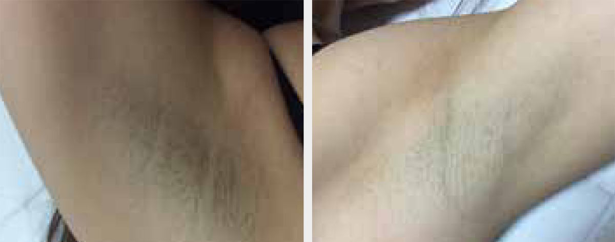 Before-After-Eneka-01