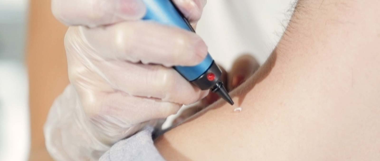 Cryopen-treatment